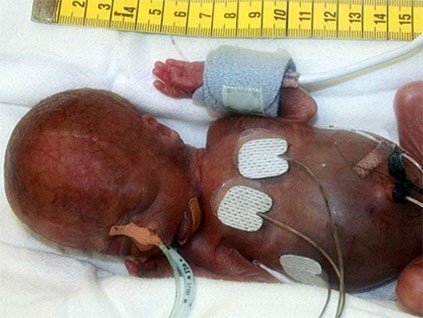 200 Gram Dünyaya gelmişti. Şimdi büyüdü bakın ne halde... galerisi resim 7