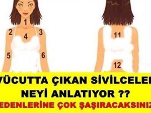 Hani kurtulamadığımız o sivilceler var ya bakın neden çıkıyormuş!