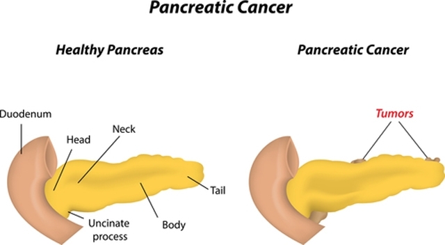 Pankreas Kanseri Belirtilerine Dikkat! galerisi resim 6