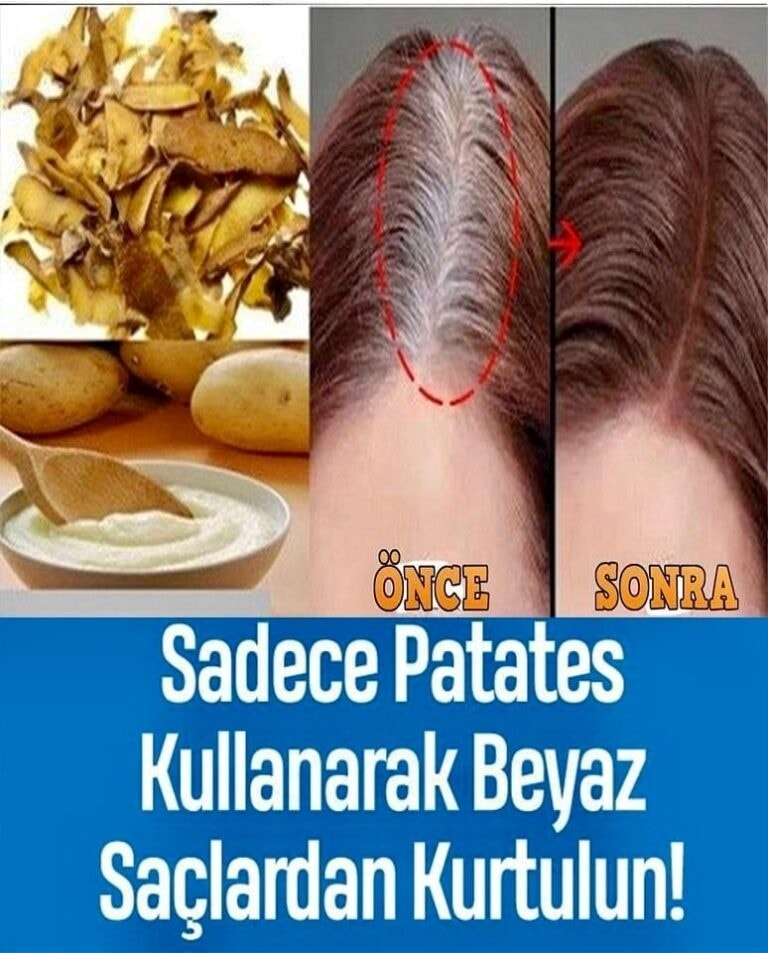 Beyaz Saça Patates Kabuğu ile Son! galerisi resim 1