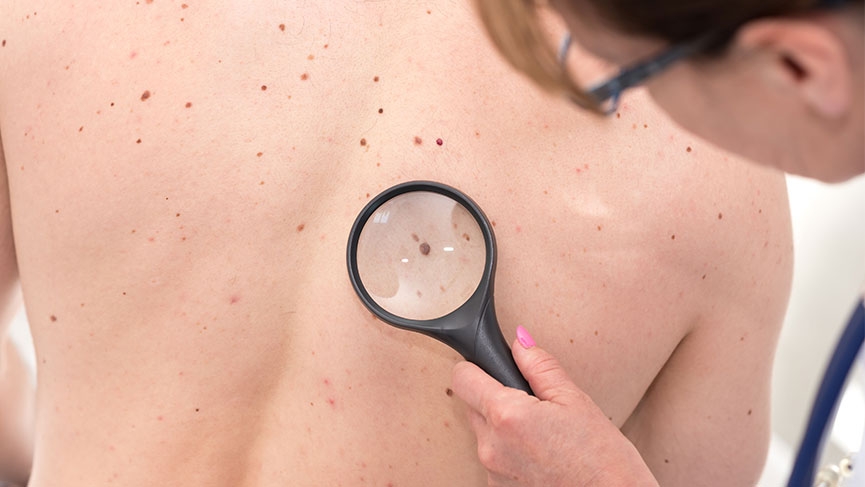 BUNLAR KANSERİN BELİRTİLERİ OLABİLİR!.. galerisi resim 3