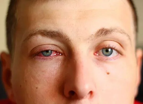 Bu Virüs Görme Kaybına Neden Oluyor galerisi resim 3