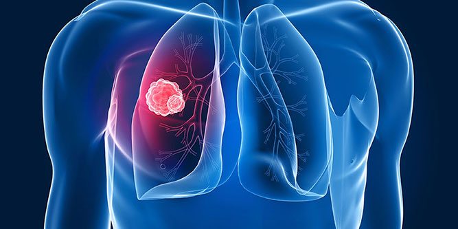 Akciğer Hastalıkları Tedavisi Nasıl Yapılır ?