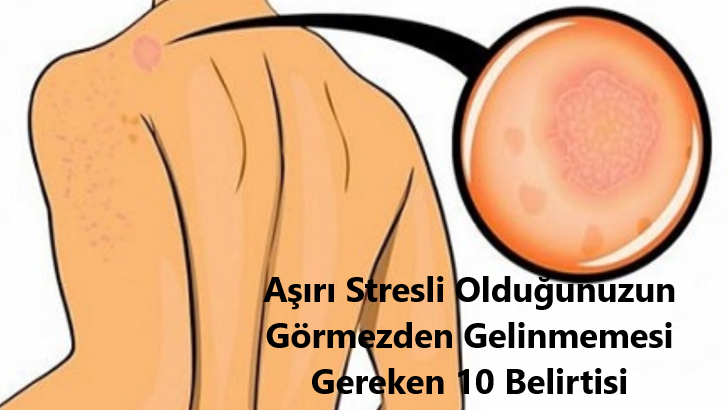 Aşırı Stresli Olduğunuzun Görmezden Gelinmemesi Gereken belirtiler