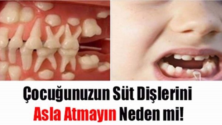 Çocuğunuzun Süt Dişlerini ASLA Atmayın! NEDEN Mİ?