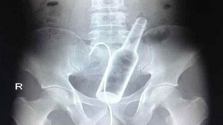 Röntgen filmlerinden çıkan akılalmaz şeyler