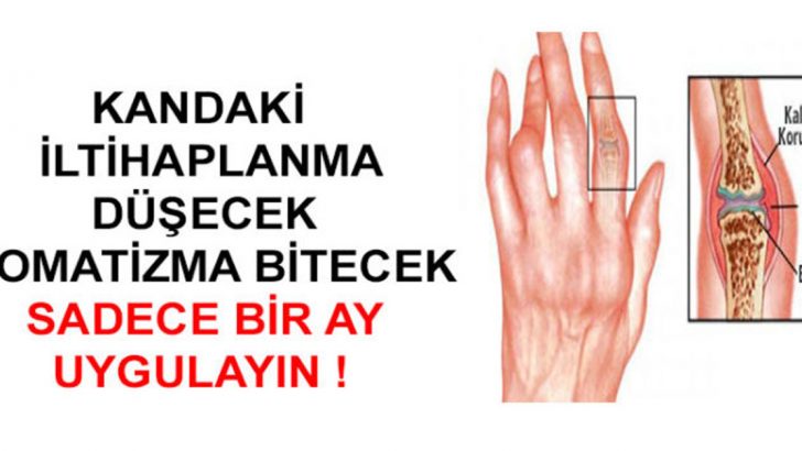 KANDAKİ İLTİHAPLANMA DÜŞECEK ROMATİZMA BİTECEK SADECE BİR AY UYGULAYIN!