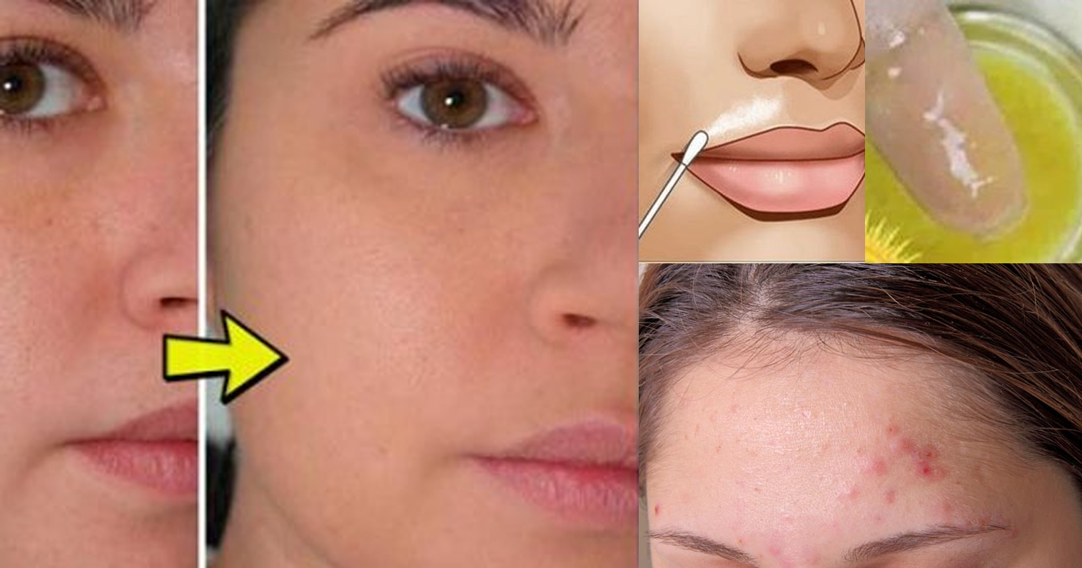 CİLT BAKIMI İÇİN HÜCRE YENİLEYİCİ İNANILMAZ KARIŞIM! PÜRÜZSÜZ BİR CİLT İÇİN…