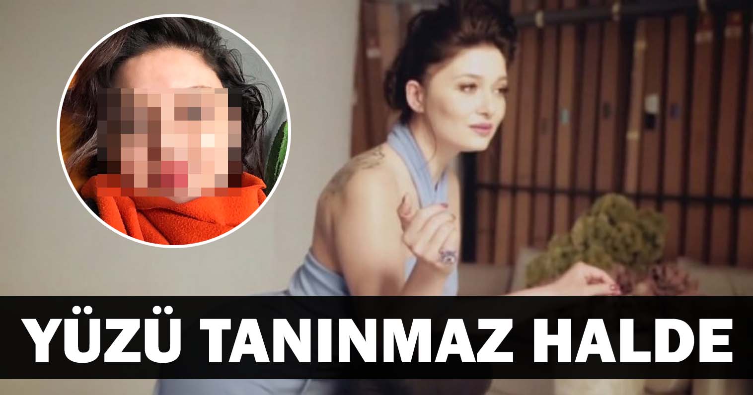 Nurgül Yeşilçay Botoks Kurbanı Oldu! Yüz Olmuş Davul..