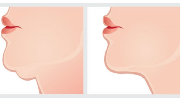ÇENE ALTINDAKİ GIDIDAN KURTULMAK İSTEYENLERİN EVDE UYGULAMASI GEREKENLER