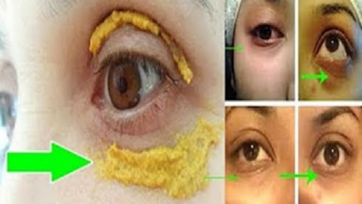 GÖZ ÇEVRENİZE 1 HAFTA BOYUNCA ZERDEÇAL SÜRÜN SONUÇLARA İNANAMAYACAKSINIZ