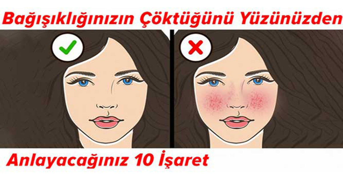 BAĞIŞIKLIĞINIZIN ÇÖKTÜĞÜNÜ YÜZÜNÜZDEN ANLAYACAĞINIZ 10 İŞARET