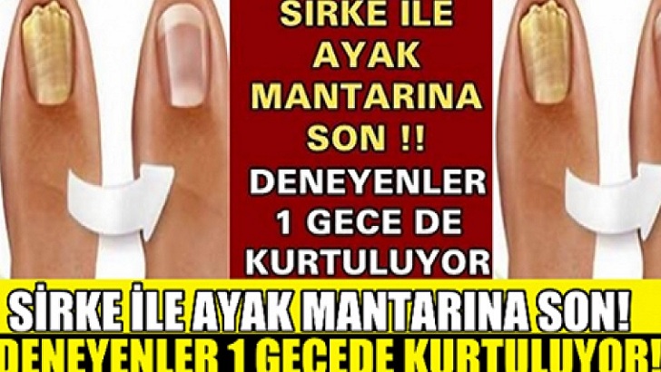 SİRKE İLE AYAK MANTARINA SON !! DENEYENLER 1 GECE DE KURTULUYOR