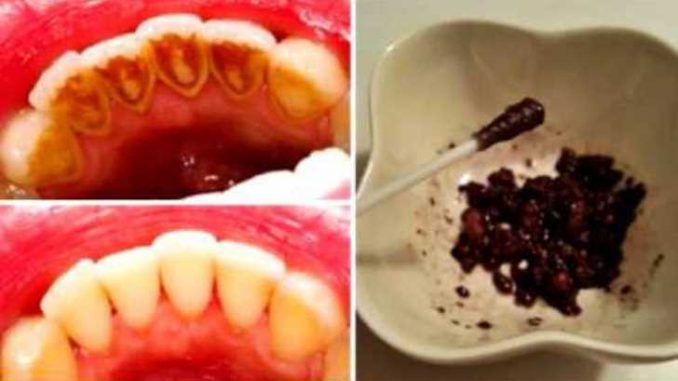 Dişleriniz İçin Artık Doktora Gitmeyeceksiniz! 1 Malzemeyle Işık Işıl Dişler