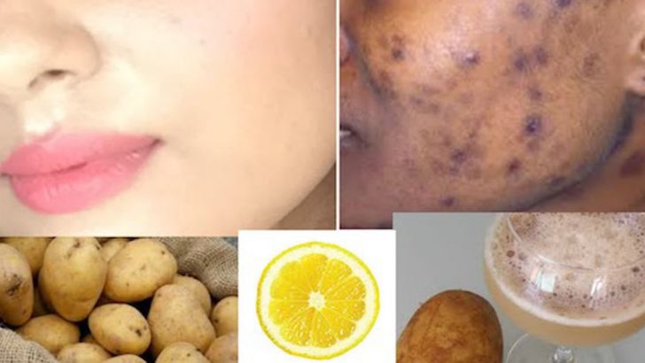 SİYAH LEKELERİ VE SİVİLCELERİ SADECE 5 GÜN İÇİNDE YOK EDER!