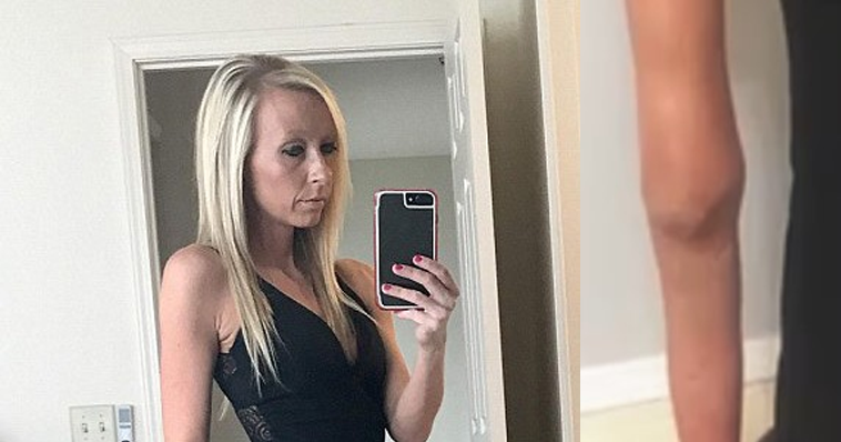 GENÇ KADIN, MİNİ ETEK GİYEBİLMEK İÇİN SAĞ BACAĞINI KESTİRDİ