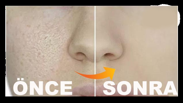 GÖZENEKLERİNİZDEN SONSUZA KADAR KURTULUN! IŞILTILI YILDIZ GİBİ BİR CİLDİNİZ OLSUN