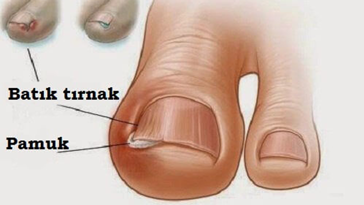 TIRNAK BATMASINDAN KURTARAN EVDE TEDAVİ YÖNTEMLERİ