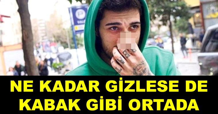 İDO TATLISES BURNUNA ESTETİK YAPTIRDI! BAKIN NE HALE DÖNDÜ