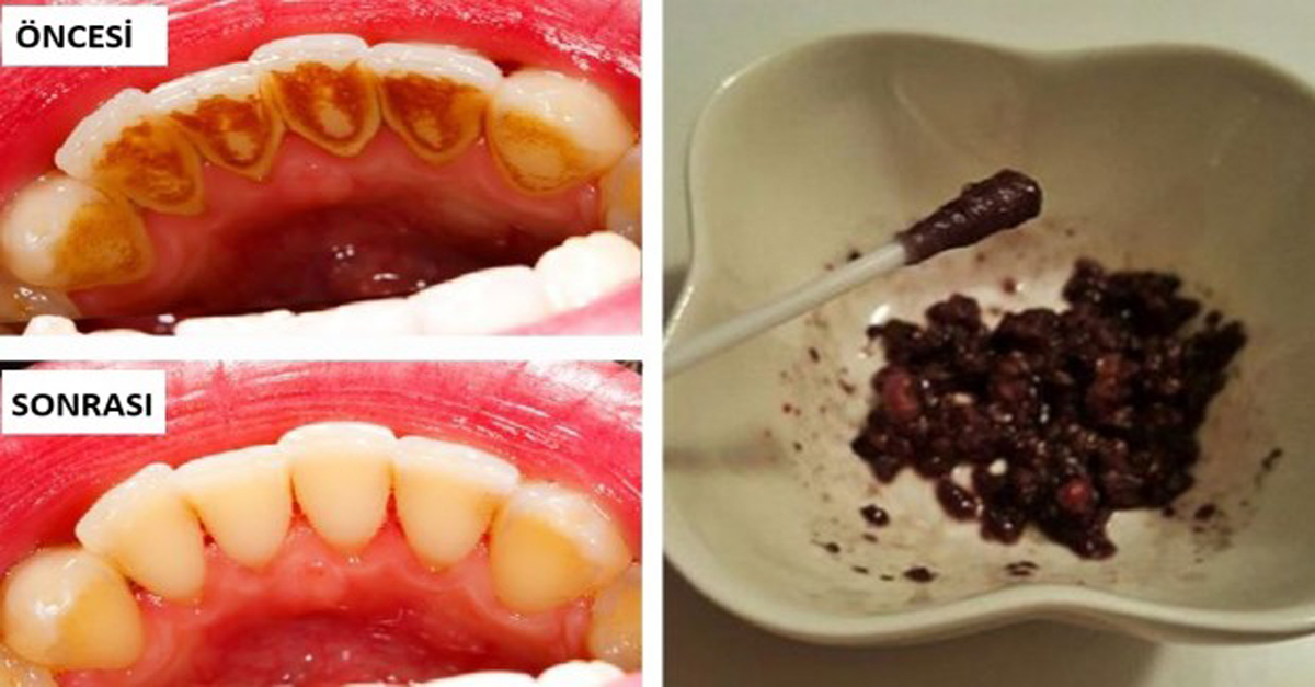 TEK MALZEMEYLE BEMBEYAZ DİŞLER SAHİP OLUN.