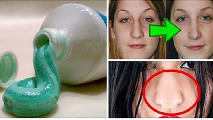 YOK ARTIK YURT DIŞINDA POPÜLER OLDU: DİŞ MACUNU İLE BURUN KÜÇÜLTME NASIL YAPILIR?