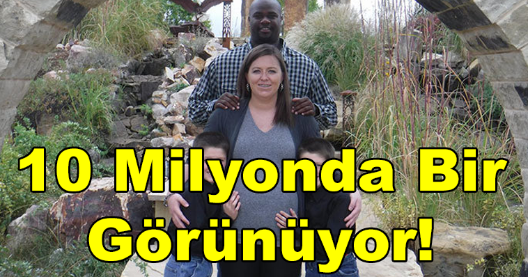 MUCİZE İKİZLER! 10 MİLYONDA 1 GÖRÜLEN DOĞUM! ŞOKE OLACAKSINIZ