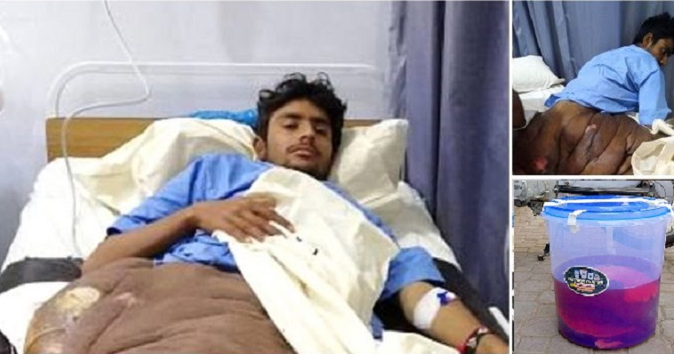 18 YAŞINDAKİ GENCİN BACAĞINDAKİ TÜMÖRÜ GÖRENLER ŞAŞTI KALDI