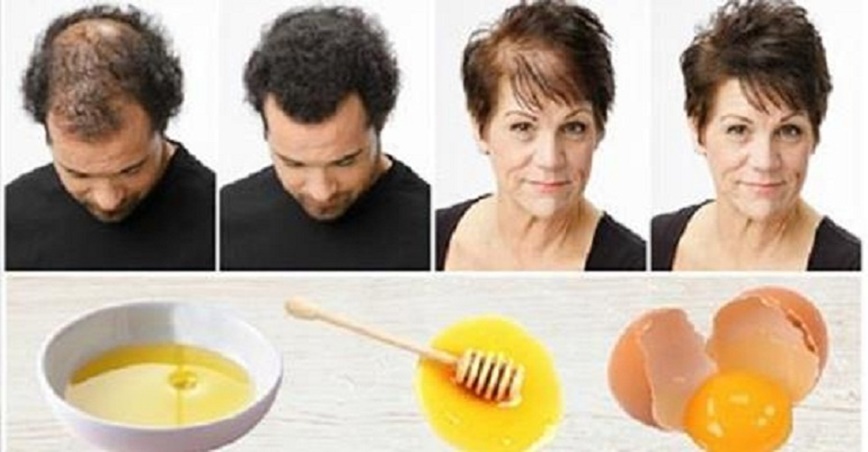Hem Saç Dökülmesi Hem de Gür ve Sağlıklı Saçlar İçin yumurta sarısı