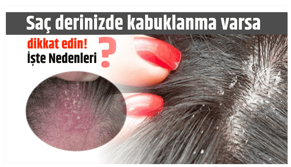 Saç Derisinde Kabuklanma Varsa DİKKAT.. Kabuklanma Neden Olur?