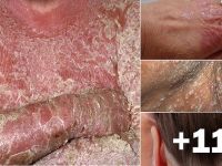 HERKESİN FİKRİNİN OLDUĞU AMA BİLGİSİNİN OLMADIĞI HASTALIK! BU BELİRTİ VARSA EĞER SİZDE…