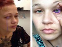 Gözünü Renklendirmek İçin Dövme Yaptıran Genç Kızın Hayatı Karardı