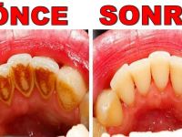 Tartar’ı Dişinizden Sonsuza Kadar Kaldıran 9 Şey