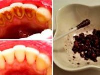 Dişleriniz İçin Artık Doktora Gitmeyeceksiniz! 1 Malzemeyle Işık Işıl Dişler