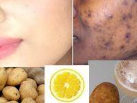 SİYAH LEKELERİ VE SİVİLCELERİ SADECE 5 GÜN İÇİNDE YOK EDER!