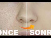 GÖZENEKLERİNİZDEN SONSUZA KADAR KURTULUN! IŞILTILI YILDIZ GİBİ BİR CİLDİNİZ OLSUN