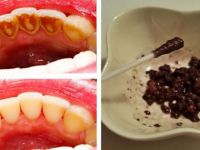 TEK MALZEMEYLE BEMBEYAZ DİŞLER SAHİP OLUN.