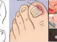 Tırnak Batması T-edavisi Aslında Bu Kadar Basitmiş