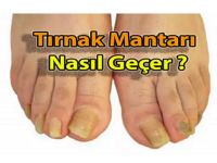 Tırnak Mantarı Nedir..? Nasıl Geçer..?