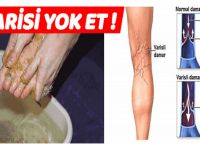 Varisli Damarları Yok Etmenin Doğal Yöntemi