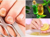 Tırnak Mantarını 1 Saatte Limon İle Temizleyin