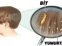 Bu Yöntemi Çok Az Doktor Biliyor, Bitten Kurtulmanın En Hızlı, Ucuz Ve Kolay Yolu