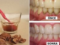 1 Malzemeyle Işık Işıl Dişler! ( Tartar, enfeksiyonlar, iltihaplı diş hastalıkları…)