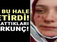 Eşi Bu Hale Getirdi ! Anlattıkları Krkunç