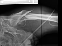 HASTALARI YATAĞA BAĞIMLI KALMAKTAN KURTARIYOR